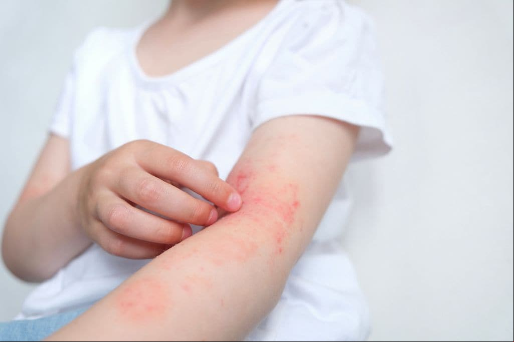 Niña rascándose lesiones de dermatitis atópica en el brazo